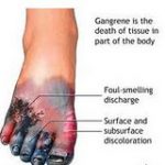 Inilah 10 tanda Penyebab Diabetes
