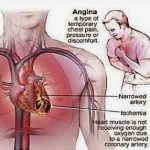 5 Tips mengurangi resiko penyakit jantung koroner