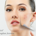 Cara Efektif Menghilangkan Jerawat