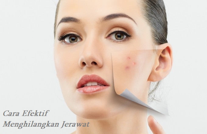 Cara Efektif Menghilangkan Jerawat