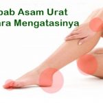 Kenali Penyebab Asam Urat Hingga Penyembuhan