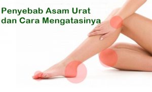 pengobatan asam urat