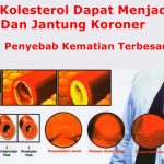 Gejala Kolesterol dan Cara Menurunkannya Secara Alami