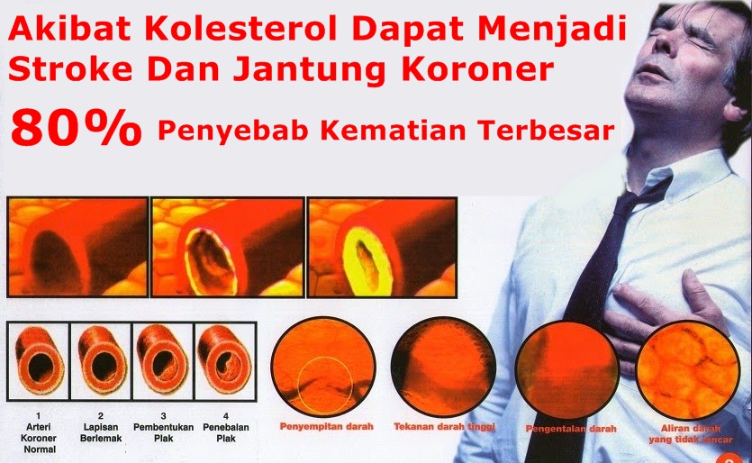 Gejala Kolesterol dan Cara Menurunkannya Secara Alami
