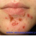 Cara Cepat Mengobati Impetigo Dengan Nasa