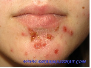 Cara Cepat Mengobati Impetigo Dengan Nasa