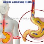 Makananan Yang Boleh dan Tidak Boleh Dimakan Bagi Penderita Asam Lambung