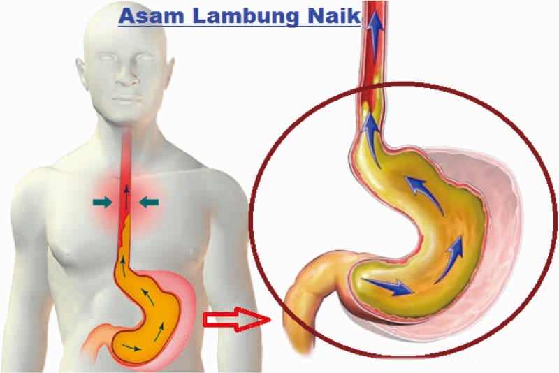 Makananan Yang Boleh dan Tidak Boleh Dimakan Bagi Penderita Asam Lambung