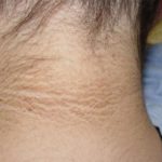 Cara Memutihkan Lipatan Kulit Yang Hitam