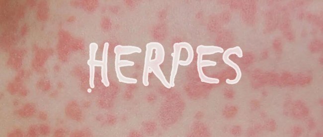 Tahapan Infeksi dan Penyembuhan Herpes