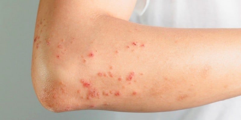 Pahami Gejala Serta Penyebab Herpes Kulit