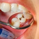 Yuk Ketahui, 7 Perawatan Gigi Ini Terbukti Hindari Gigi Berlubang